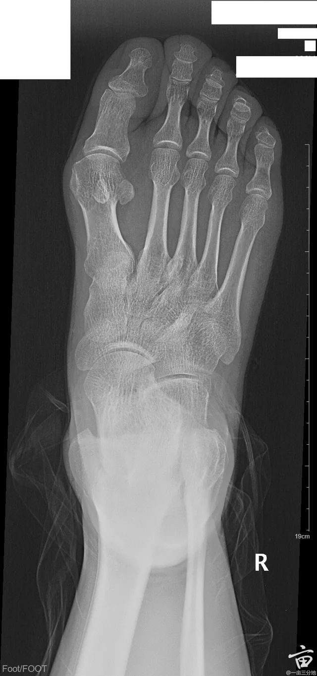 gouty-hallux-valgus-secondary-to-mtp-joint-arthropathy-v0-znm2csnd1x8f1.jpg